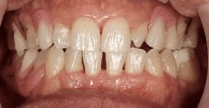 中等度歯周病の画像