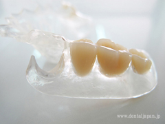 クラスプ部分が透明な「アルティメットクリア義歯」