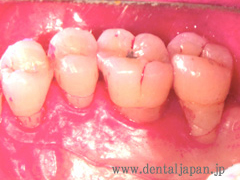 歯周病患者のための義歯