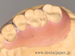 歯周病患者のための義歯