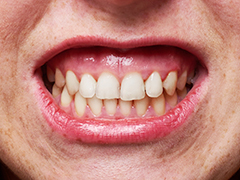 歯周病の原因 歯茎から血が出る 港区浜松町 大西歯科モノレールビルクリニック