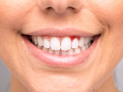 歯周病の原因 歯茎から血が出る 大西歯科モノレールビルクリニック