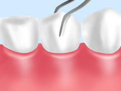 歯周病の症状 歯がグラグラする 歯がぐらつく 大西歯科モノレールビルクリニック