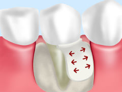 GTR法（歯周組織誘導法）