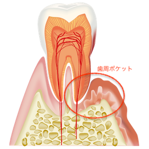 歯周ポケットと歯石・歯垢の図