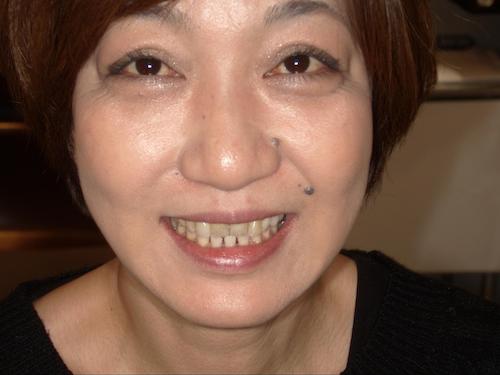 術前正面