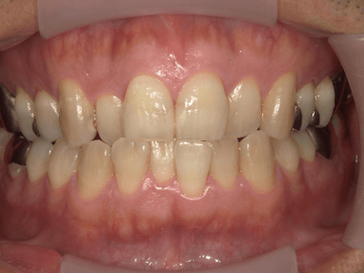 軽度歯周病　術後の口腔内写真