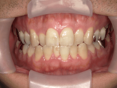 軽度歯周病　術前の口腔内写真