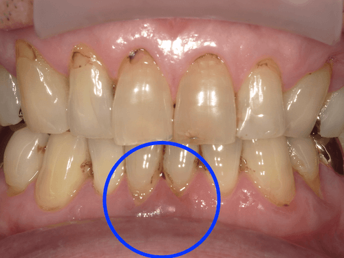 中等度歯周病の画像