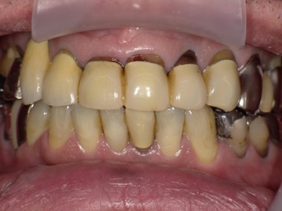 前歯の審美的理由でお悩みではありませんか？