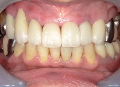 60代男性の前歯のセラミック治療：術後