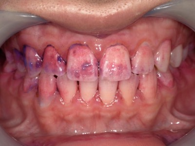 歯肉炎　術中の口腔内写真