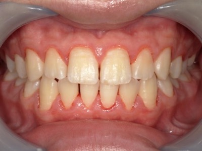 歯肉炎　術中の口腔内写真