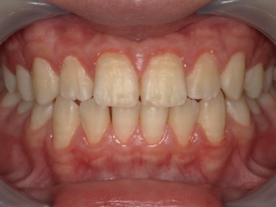 歯肉炎　術後の口腔内写真