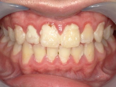 歯肉炎　術前の口腔内写真